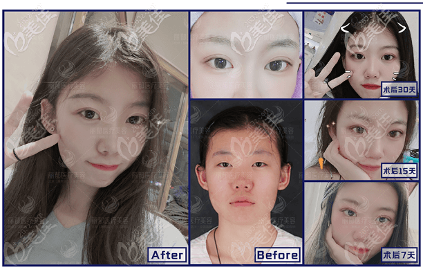 北京米蘭柏羽麗都曹衛(wèi)華做眼睛怎么樣？8度美瞳術(shù)雙眼皮案例效果展示