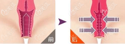 陰道緊縮手術(shù)效果 陰道緊縮手術(shù)效果