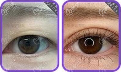 斯美諾雙眼皮整形真人前后對比照