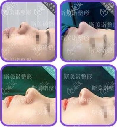 斯美諾鼻部整形真人前后對比效果照