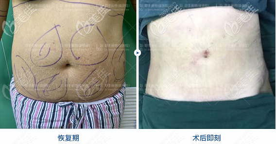 鄭荃算不算重慶脂肪填充有名醫(yī)生得看他的自體脂肪面部填充和吸脂案例