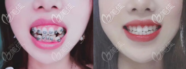 女生有顆虎牙長(zhǎng)歪了往外翹，摘下日本TOMY自鎖金屬托槽后著實(shí)令人驚嘆！