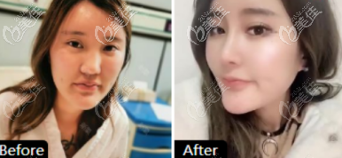 如果你是淄博的妹子不知道如何選隆鼻醫(yī)院，那就來(lái)看看這三個(gè)案例吧