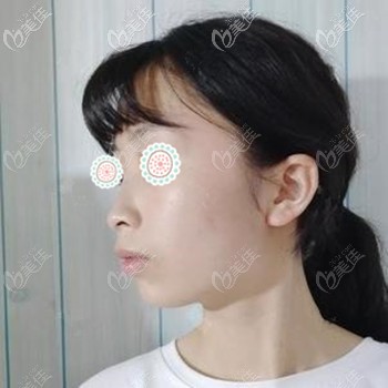 做肋骨鼻前的鼻型問題 做肋骨鼻前的鼻型問題