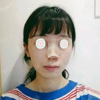 做肋骨鼻的第四天 做肋骨鼻的第四天