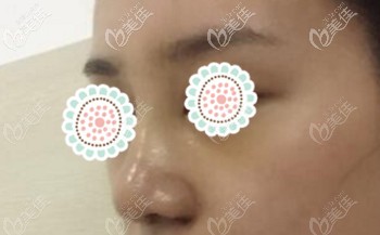 做肋軟骨隆鼻后的一個月 做肋軟骨隆鼻后的一個月