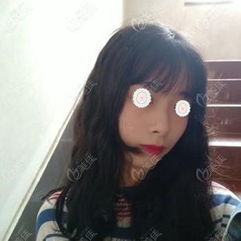 做肋軟骨隆鼻后鼻梁高挺 做肋軟骨隆鼻后鼻梁高挺