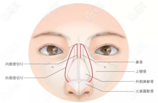 鼻骨內(nèi)推手術(shù)原理
