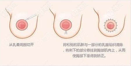 雙環(huán)法乳房下垂矯正手術(shù) 雙環(huán)法乳房下垂矯正手術(shù)