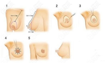 乳房塑形懸吊法 乳房塑形懸吊法