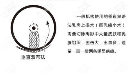 垂直雙蒂法胸下垂矯正 垂直雙蒂法胸下垂矯正