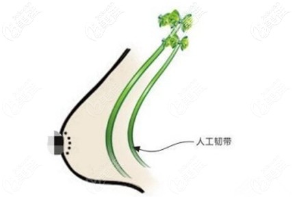 人工韌帶乳房上提術(shù) 人工韌帶乳房上提術(shù)