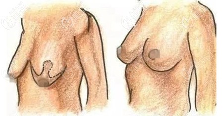 乳房懸吊術(shù)后疤痕照片 乳房懸吊術(shù)后疤痕照片