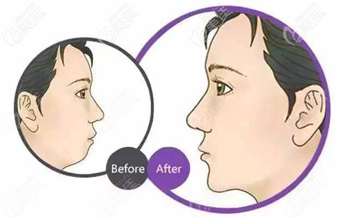 下巴短縮顯得土氣 下巴短縮顯得土氣