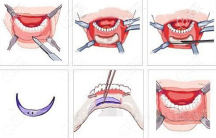 膨體墊下巴過程 膨體墊下巴過程