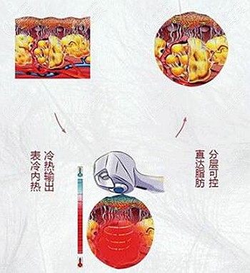 BTL射頻溶脂的原理