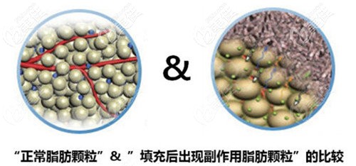 脂肪填充過(guò)量脂肪形成硬結(jié)團(tuán)塊示意圖