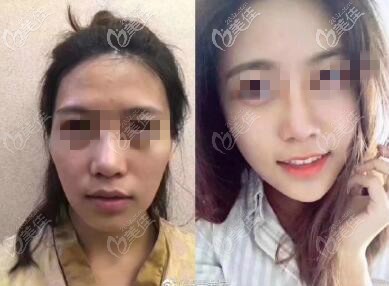 面頰局部脂肪填充過(guò)量修復(fù)效果圖