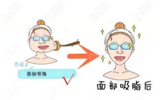 面部吸脂前后對比照片 面部吸脂前后對比照片