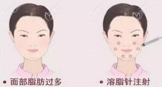 面部溶脂針瘦臉 面部溶脂針瘦臉