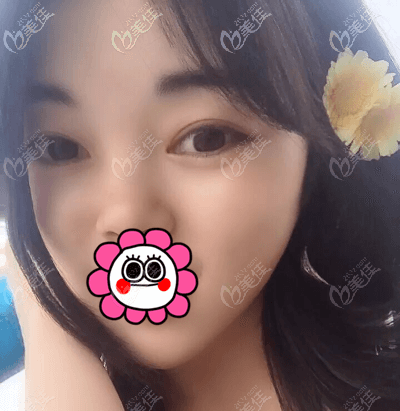 北京畫美徐學東醫(yī)生給我做雙眼皮半個月<span style=