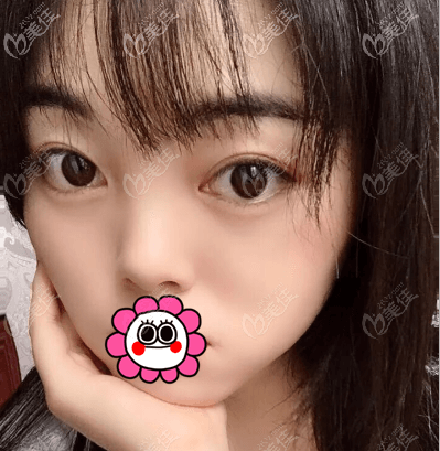 打聽(tīng)到做眼睛好的徐學(xué)東醫(yī)生在北京畫(huà)美醫(yī)院坐診我就做了雙眼皮你覺(jué)得怎么樣