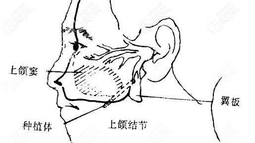 上頜翼板區(qū)種植技術(shù)
