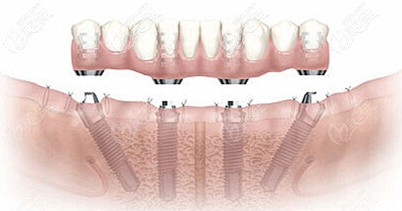 All-On-Four半口種植牙技術(shù)