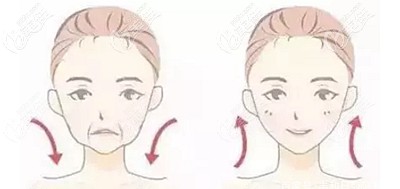 面部埋線提升的副作用 面部埋線提升的副作用