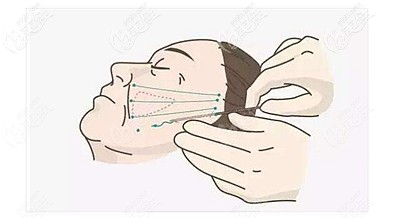 面部埋線提升后有腫脹期 面部埋線提升后有腫脹期