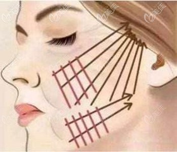 面部埋線提升前需要進行設計 面部埋線提升前需要進行設計