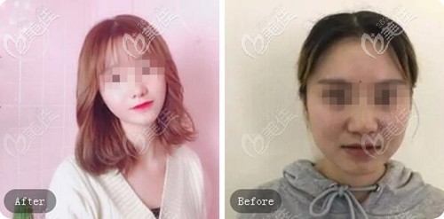 蘭州皙妍麗自體脂肪填充案例