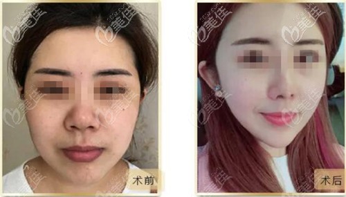 蘭州韓美面部脂肪填充對(duì)比案例