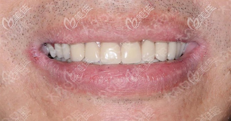 全口戴牙后照片 全口戴牙后照片