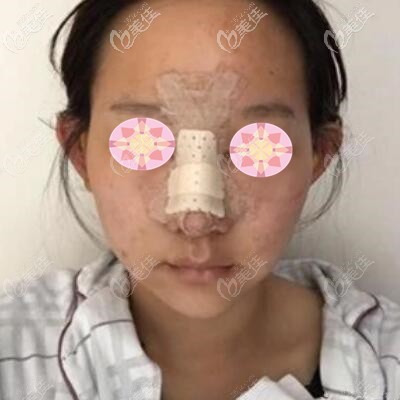 假體隆鼻術(shù)后第2天