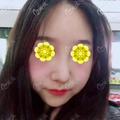 假體隆鼻半個(gè)月恢復(fù)照