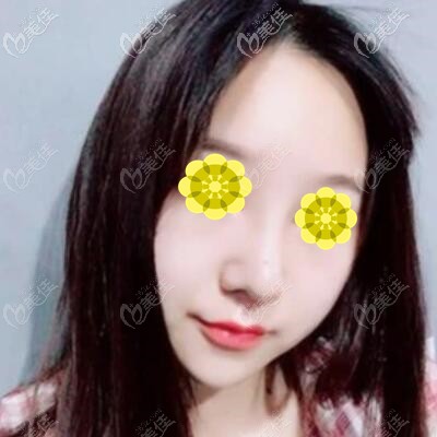 假體隆鼻1個(gè)月時(shí)的效果照