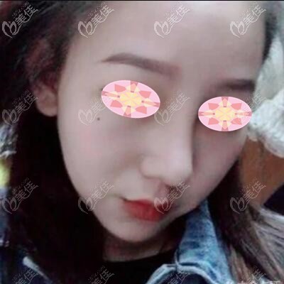 做假體隆鼻2個(gè)月時(shí)的效果照