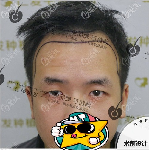 發(fā)際線種植術(shù)前設(shè)計(jì)圖 發(fā)際線種植術(shù)前設(shè)計(jì)圖