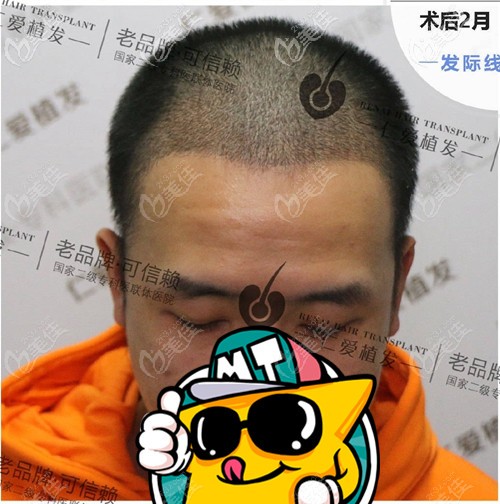 發(fā)際線植發(fā)術(shù)后2個(gè)月效果 發(fā)際線植發(fā)術(shù)后2個(gè)月效果
