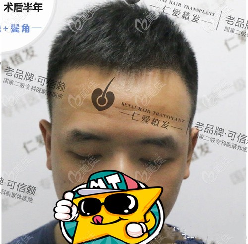 你們猜我在做的m發(fā)際線植發(fā)一次多少錢(qián)?順便展示下種植1000個(gè)毛囊面積圖片