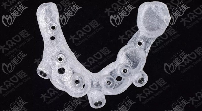 打印完成的上頜種植導(dǎo)板 打印完成的上頜種植導(dǎo)板