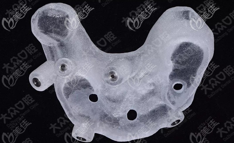 這是打印完的下頜骨種植導(dǎo)板 這是打印完的下頜骨種植導(dǎo)板