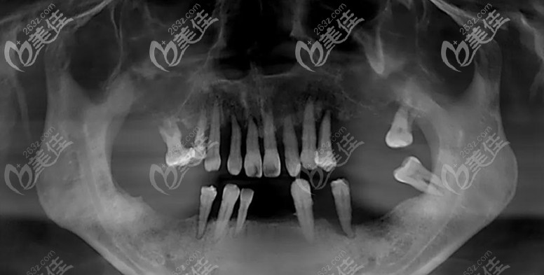 顧客種植前的口腔照 顧客種植前的口腔照