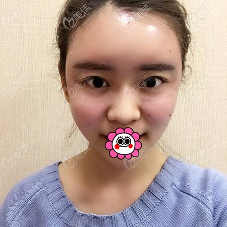 面部脂肪填充后臉有點(diǎn)腫