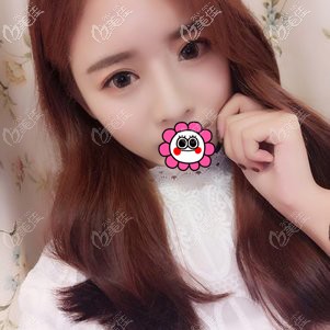 面部脂肪填充恢復(fù)兩個(gè)月案例