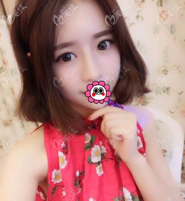 面部脂肪填充多久恢復(fù)自然？我找嘉興曙光高峻做面部脂肪填充恢復(fù)半年后少女感十足