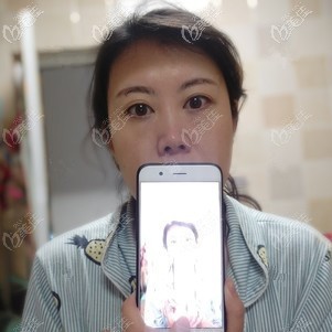 術前眼袋比較明顯 術前眼袋比較明顯