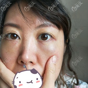 祛眼袋術后3天沒有腫脹 祛眼袋術后3天沒有腫脹