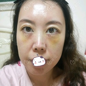 做去眼袋術后一周基本恢復 做去眼袋術后一周基本恢復